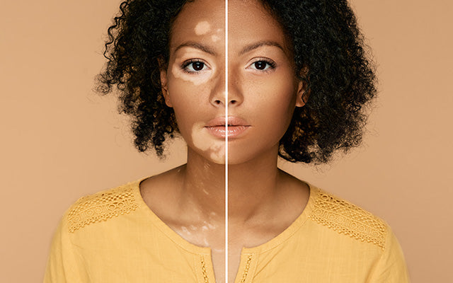vrouwen zonder vitiligo