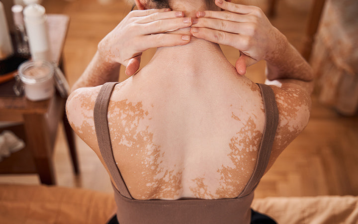 terugaanzicht van vrouw met vitiligo huid die crème aanbrengt