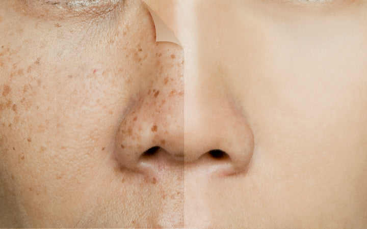 voor en na het retoucheren van sproeten op het gezicht van de Aziatische vrouw