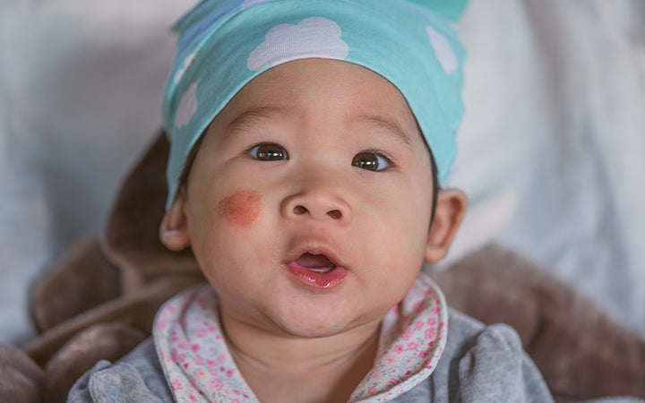 pityriasis alba op baby's gezicht atopisch