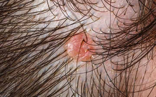 8 soorten hoofdhuid folliculitis &manieren om zich te ontdoen van hen