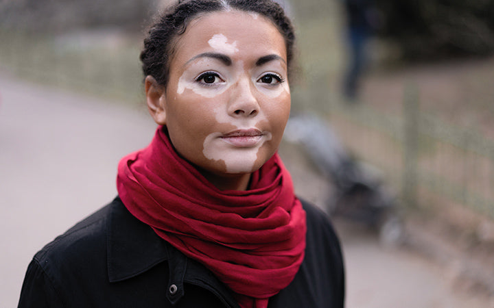 Vitiligo: Types, Symptomen, Diagnose & Behandelingen
