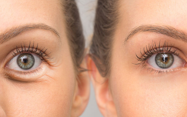 Under Eye Rimpels: Leeftijdsfactor, Oorzaken, Behandelingen & Preventie