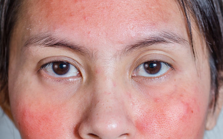 Roodheid op het gezicht: 15 oorzaken &8 manieren om het te verminderen