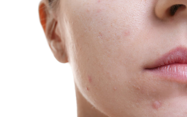 Periode acne - Waarom het gebeurt en hoe je er vanaf kunt komen