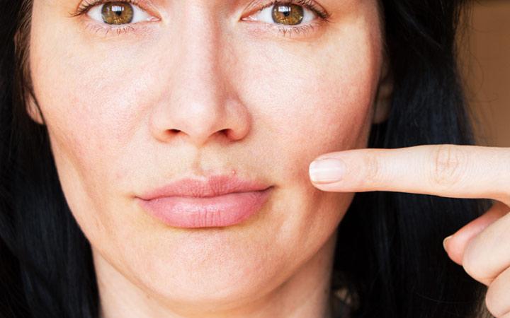 Hoe puistje op de lip te behandelen: oorzaken + preventietips