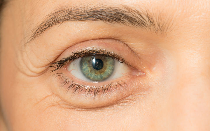Gezwollen ogen: triggers, behandelingen en voedingsmiddelen om te eten / vermijden
