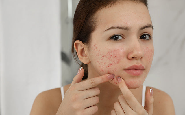 Puistjes vs koortslip op de huid: oorzaken, behandelingen & preventie