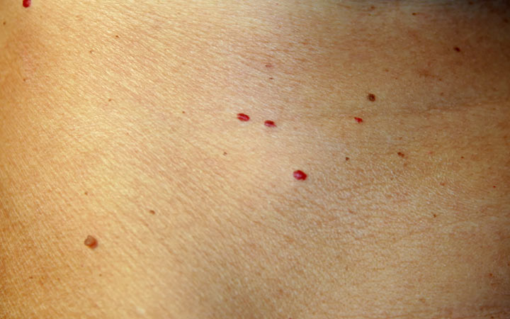 Wat veroorzaakt rode vlekken op de huid &hoe ze te behandelen