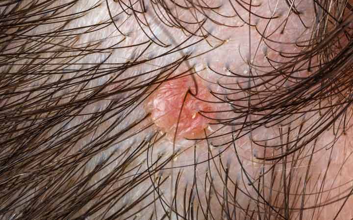 8 soorten hoofdhuid folliculitis &manieren om zich te ontdoen van hen