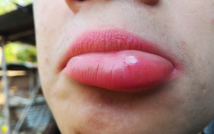 Gezwollen lippen: oorzaken, Huismiddeltjes, Medische behandelingen & Voorzorgsmaatregelen