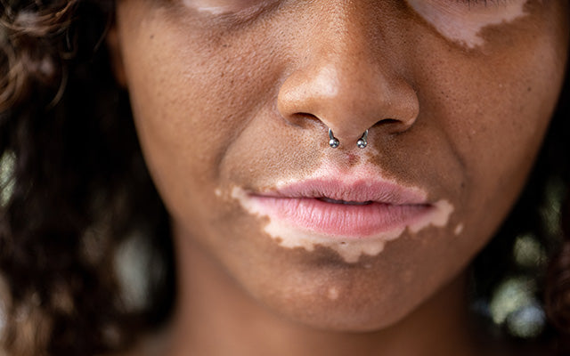 Vitiligo op de lippen – Oorzaken, Behandelingen &nuttige tips
