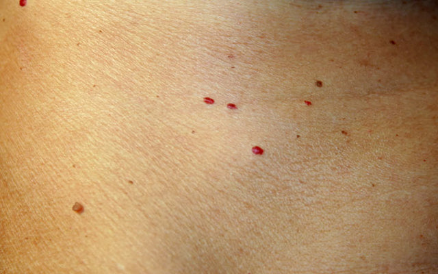 Wat veroorzaakt rode vlekken op de huid &hoe ze te behandelen