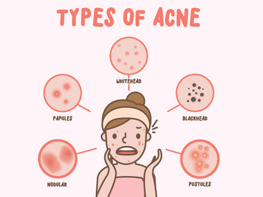 Wat zijn de verschillende soorten acne en hoe ze te behandelen
