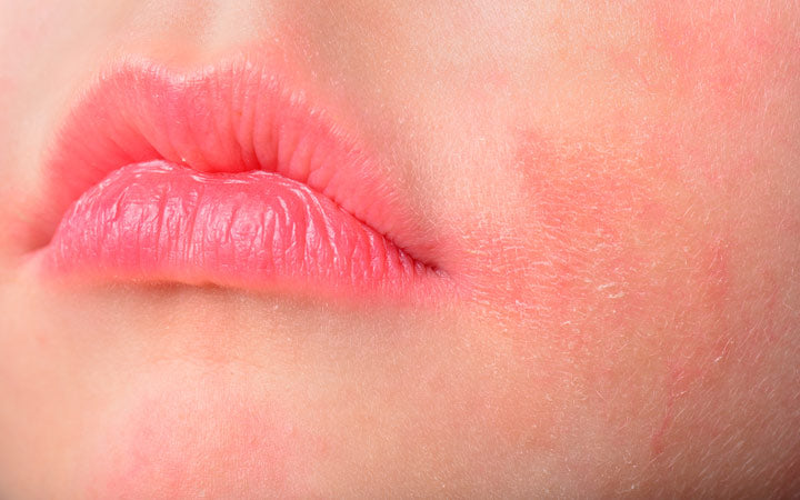 Hoe kun je huiduitslag op je lippen voorkomen?